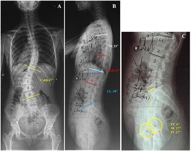 PI and T9-SPI: New Predictive Factors for Increased Kyphosis of the Thoracolumbar Junction in Thoracolumbar/Lumbar Adolescent Idiopathic Scoliosis